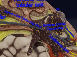 Breast Cancer types spread labelled detail 3D Model