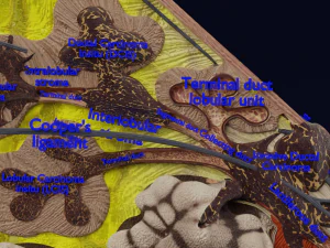 Breast Cancer types spread labelled detail 3D Model
