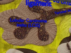 Breast Cancer types spread labelled detail 3D Model