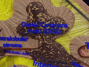 Breast Cancer types spread labelled detail Modelo 3D