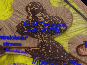 Breast Cancer types spread labelled detail 3D Model