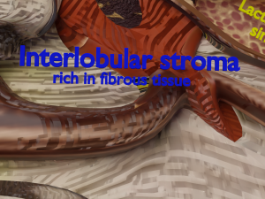 Breast Cancer types spread labelled detail Modelo 3D