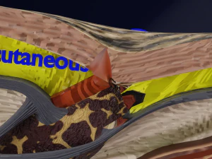 Breast Cancer types spread labelled detail 3D Model