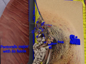 Breast Cancer types spread labelled detail 3D Model