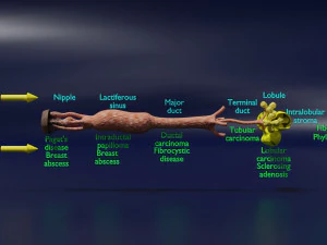 Breast duct sites and diseases 3D Model