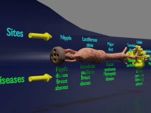 Breast duct sites and diseases 3D Model