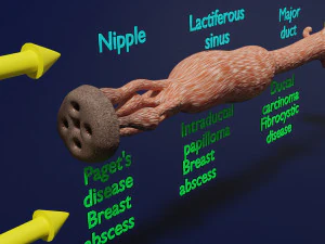 Breast duct sites and diseases 3D Model