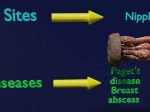 Breast duct sites and diseases 3D Model