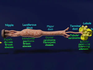Breast duct sites and diseases 3D Model