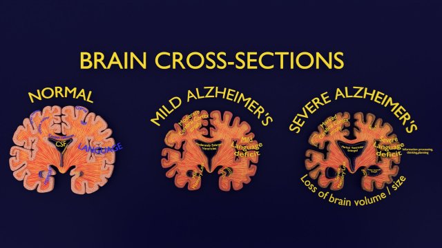 Alzheimer Disease Brain coronal slice 3D Model .c4d .max .obj .3ds .fbx .stl .blend 