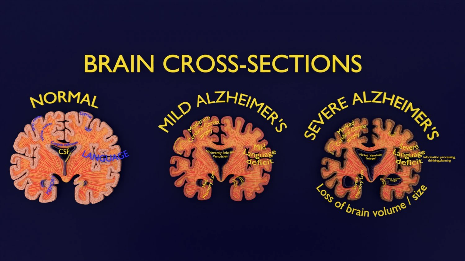 Alzheimer Disease Brain coronal slice 3D Model .c4d .max .obj .3ds .fbx .stl .blend 