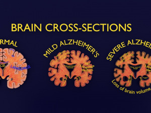 Alzheimer Disease Brain coronal slice Model 3D