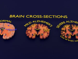 Alzheimer Disease Brain coronal slice 3D Model