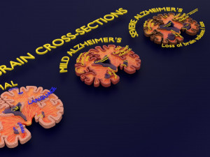 Alzheimer Disease Brain coronal slice 3D Model