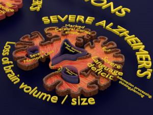 Alzheimer Disease Brain coronal slice 3D Model