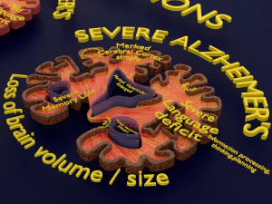 Alzheimer Disease Brain coronal slice 3D Model