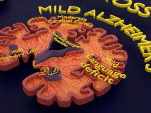 Alzheimer Disease Brain coronal slice 3D Model