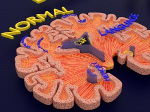 Alzheimer Disease Brain coronal slice 3D Model