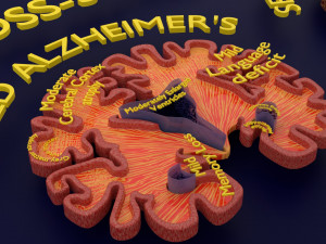 Alzheimer Disease Brain coronal slice 3D Model