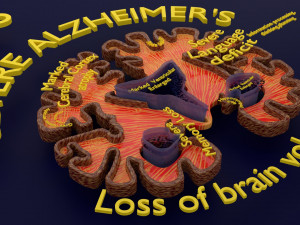 Alzheimer Disease Brain coronal slice 3D Model