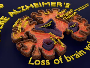 Alzheimer Disease Brain coronal slice 3D Model