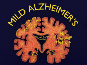 Alzheimer Disease Brain coronal slice 3D Model