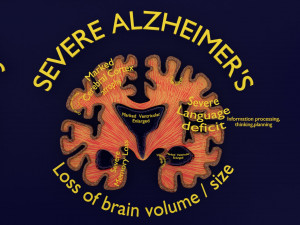 Alzheimer Disease Brain coronal slice 3D Model