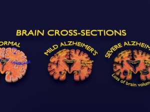 Alzheimer Disease Brain coronal slice 3D Model
