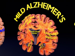 Alzheimer Disease Brain coronal slice 3D Model