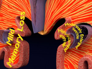 Alzheimer Disease Brain coronal slice 3D Model