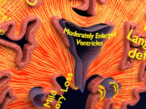 Alzheimer Disease Brain coronal slice 3D Model