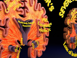 Alzheimer Disease Brain coronal slice 3D Model