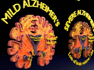 Alzheimer Disease Brain coronal slice 3D Model