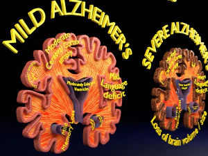 Alzheimer Disease Brain coronal slice 3D Model