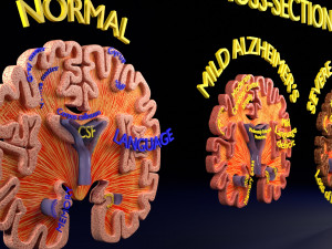 Alzheimer Disease Brain coronal slice 3D Model
