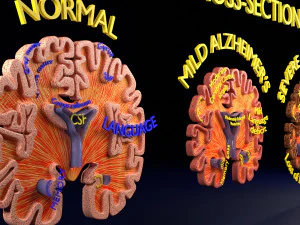 Alzheimer Disease Brain coronal slice 3D Model