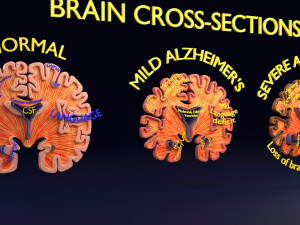 Alzheimer Disease Brain coronal slice 3D Model