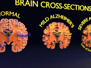 Alzheimer Disease Brain coronal slice 3D Model