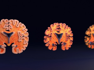 Alzheimer Disease Brain coronal slice 3D Model