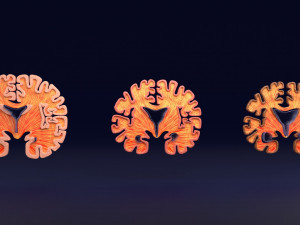 Alzheimer Disease Brain coronal slice 3D Model