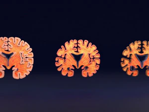 Alzheimer Disease Brain coronal slice 3D Model