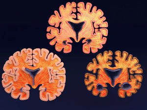 Alzheimer Disease Brain coronal slice 3D Model