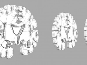 Alzheimer Disease Brain coronal slice 3D Model