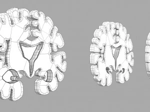 Alzheimer Disease Brain coronal slice 3D Model