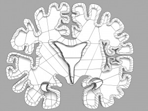 Alzheimer Disease Brain coronal slice 3D Model