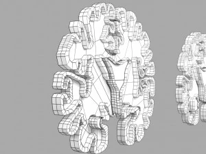 Alzheimer Disease Brain coronal slice 3D Model