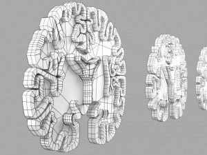 Alzheimer Disease Brain coronal slice 3D Model
