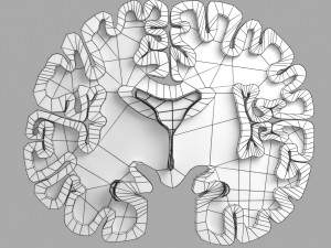 Alzheimer Disease Brain coronal slice 3D Model