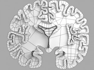 Alzheimer Disease Brain coronal slice 3D Model