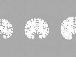 Alzheimer Disease Brain coronal slice 3D Model